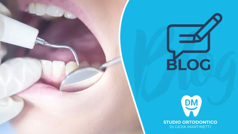 Allineatori trasparenti evoluzione nuove possibilit&agrave; ricerca