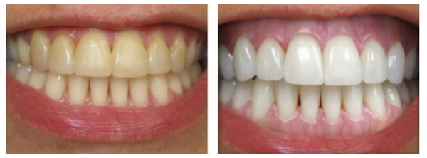 Sbiancamento dentale: la rinascita del sorriso