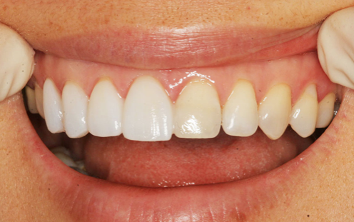 Faccette dentali: Il trucco per rivoluzionare il tuo sorriso