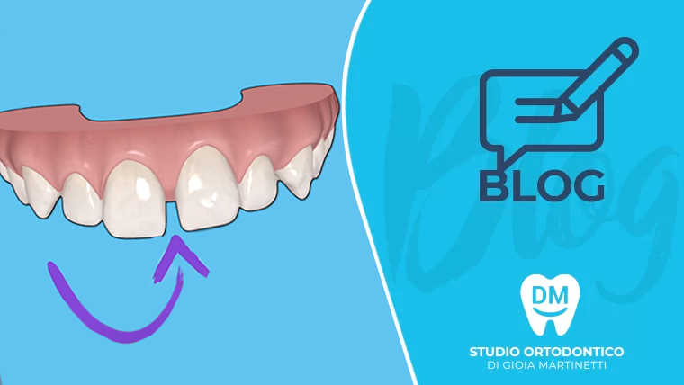 Spazio tra i denti frenulo basso, come chiuderlo con l’ortodonzia? Allineatori trasparenti? Diastemi
