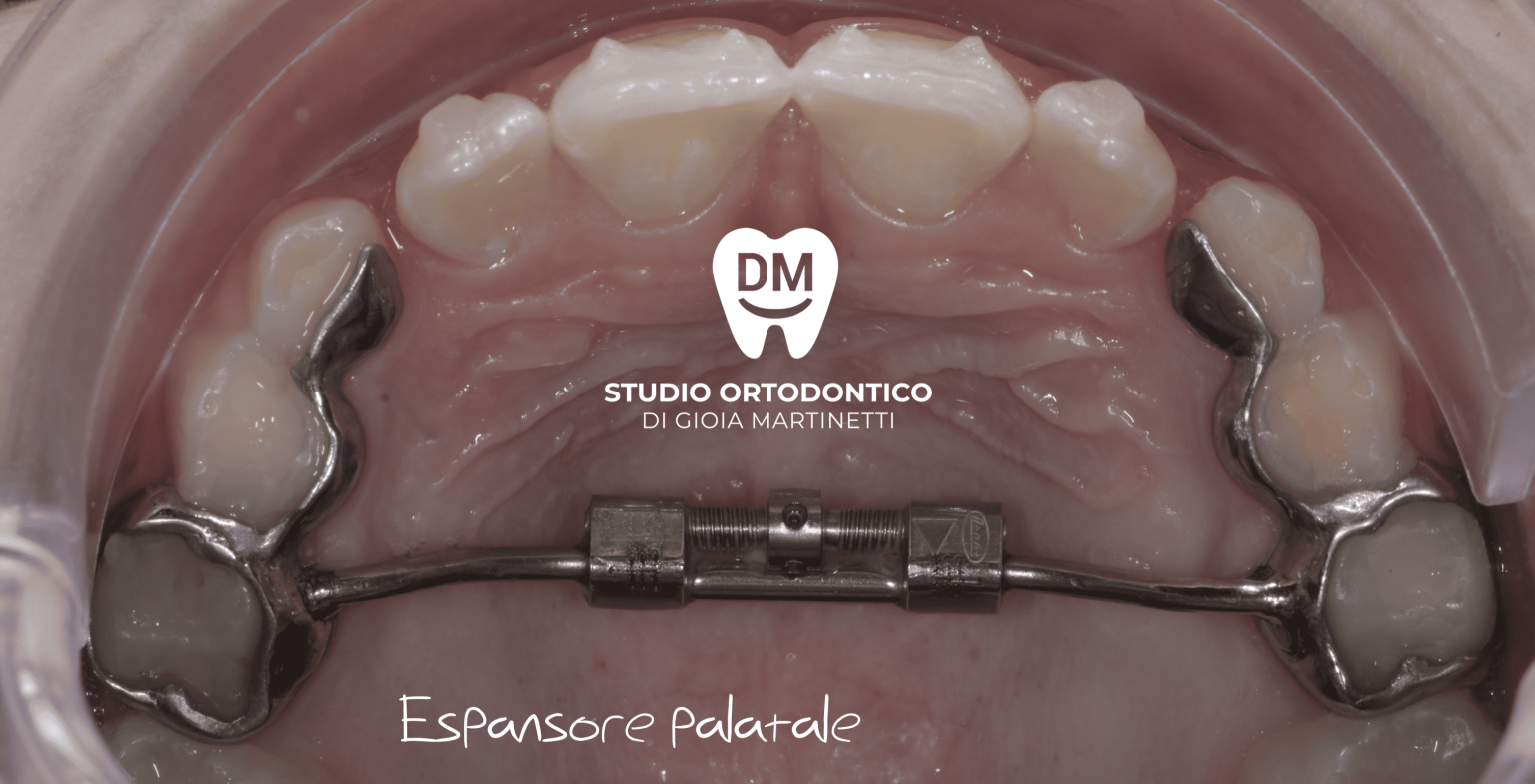 Espansore Palatale La Soluzione Per Problemi Ortodontici E Respiratori 