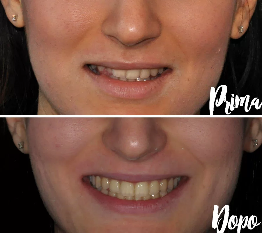 Invisalign