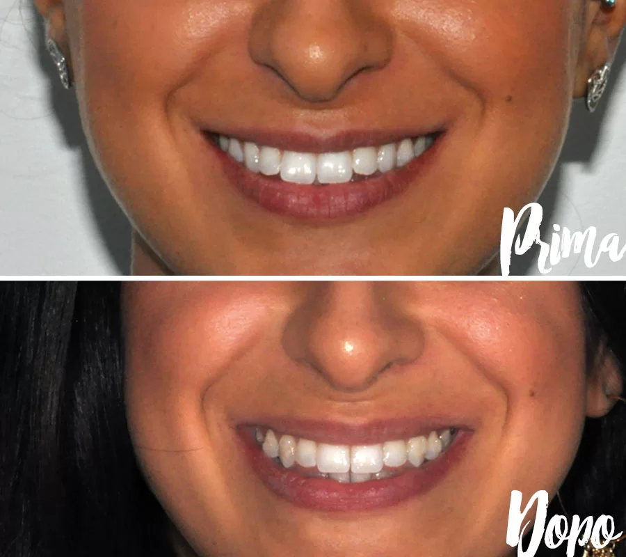 Invisalign