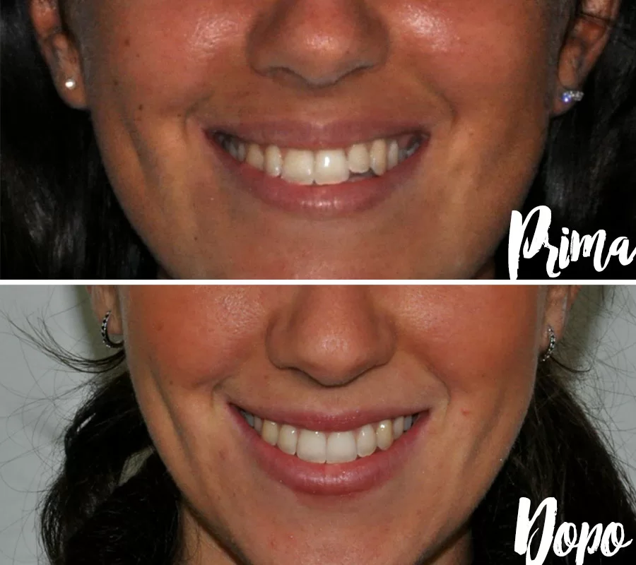 Invisalign