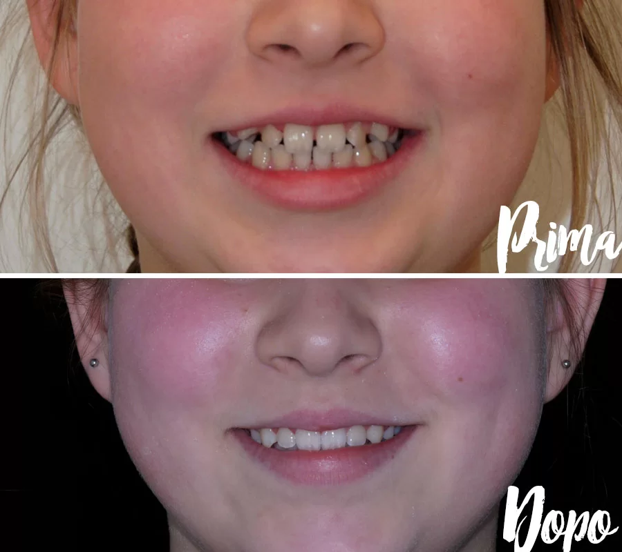 Invisalign