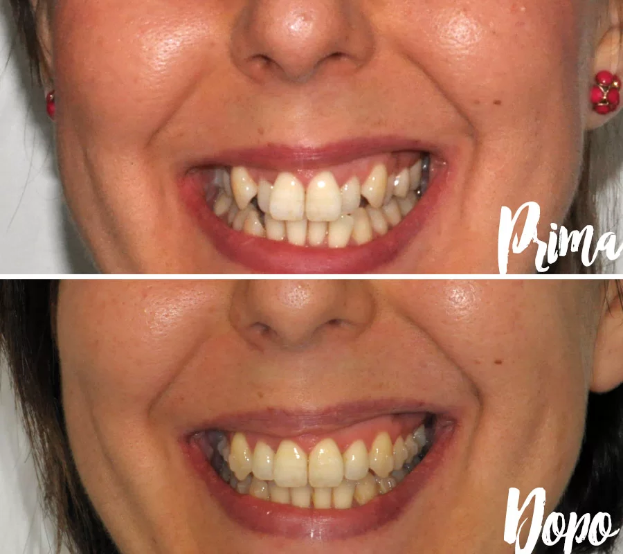 Invisalign