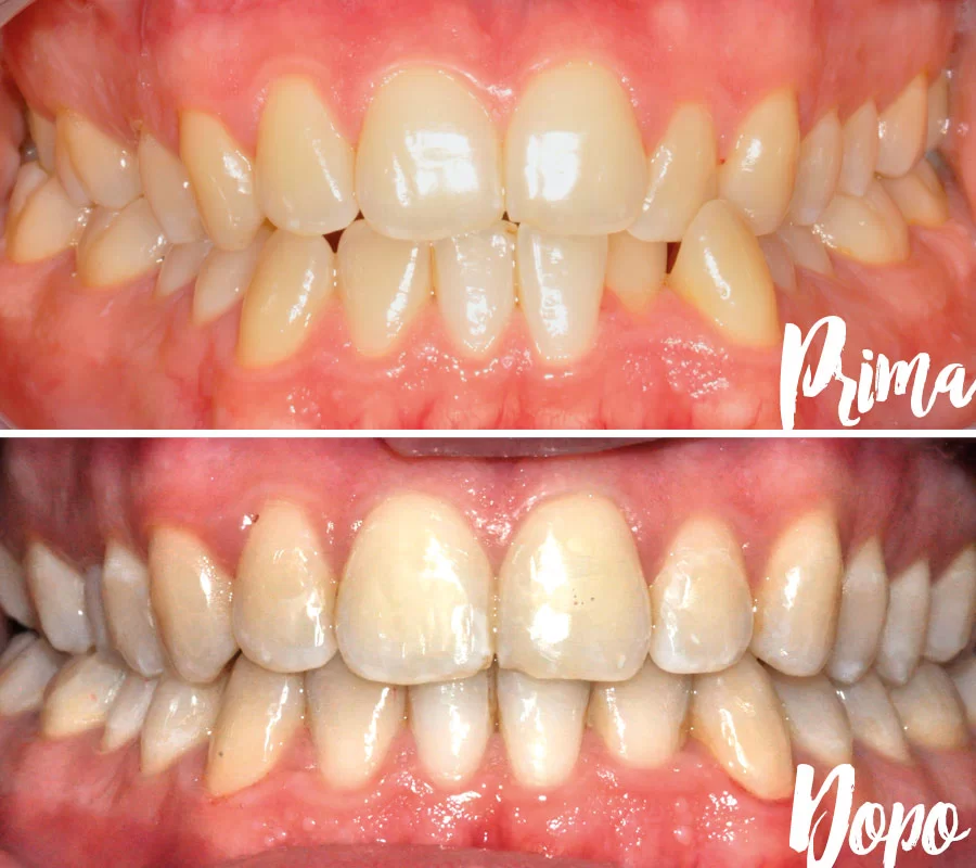 Invisalign