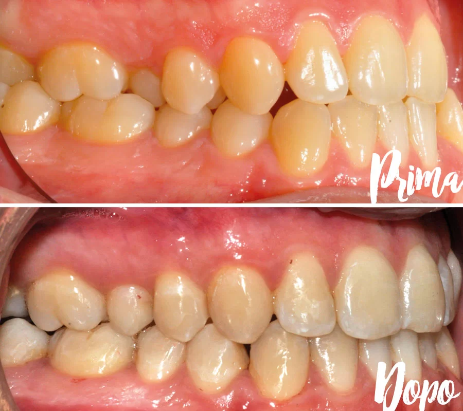 Invisalign