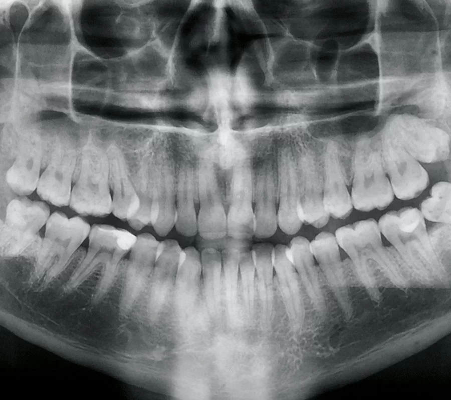 Invisalign