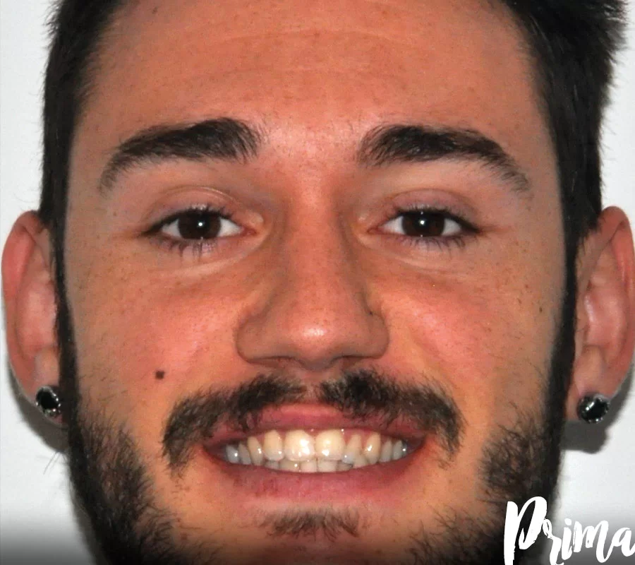 Invisalign
