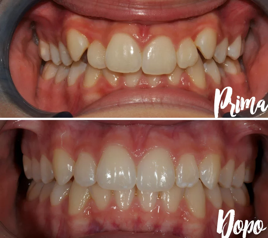 Invisalign