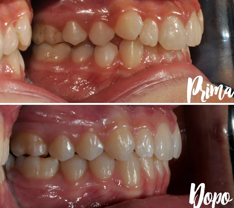 Invisalign