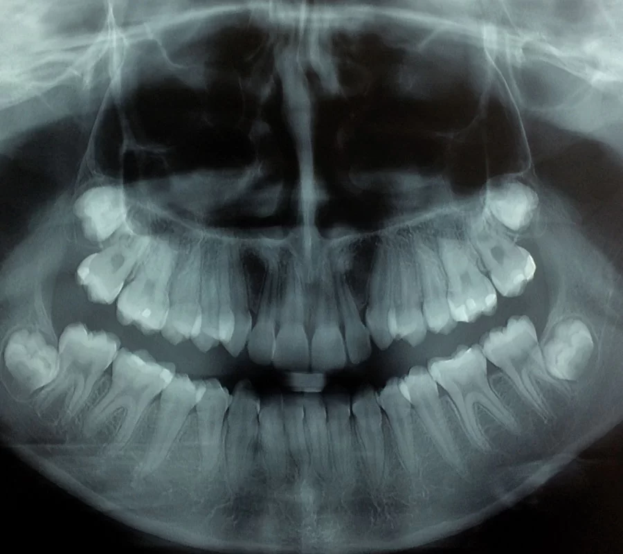 Invisalign