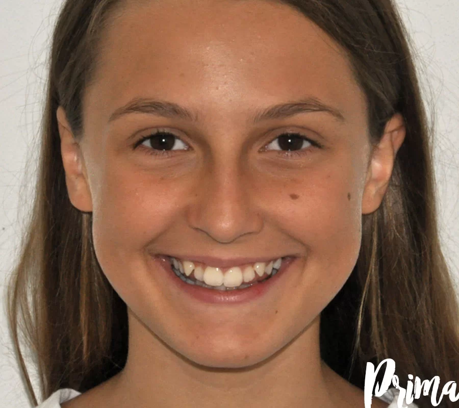 Invisalign