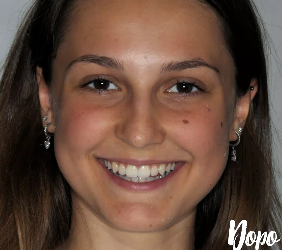 Invisalign