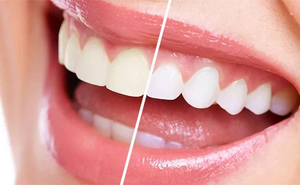 Sbiancamento dentale