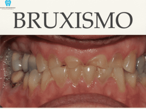 Digrignare i Denti nel Sonno: Cos'&egrave; il Bruxismo Infantile?