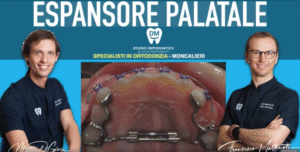 espansore