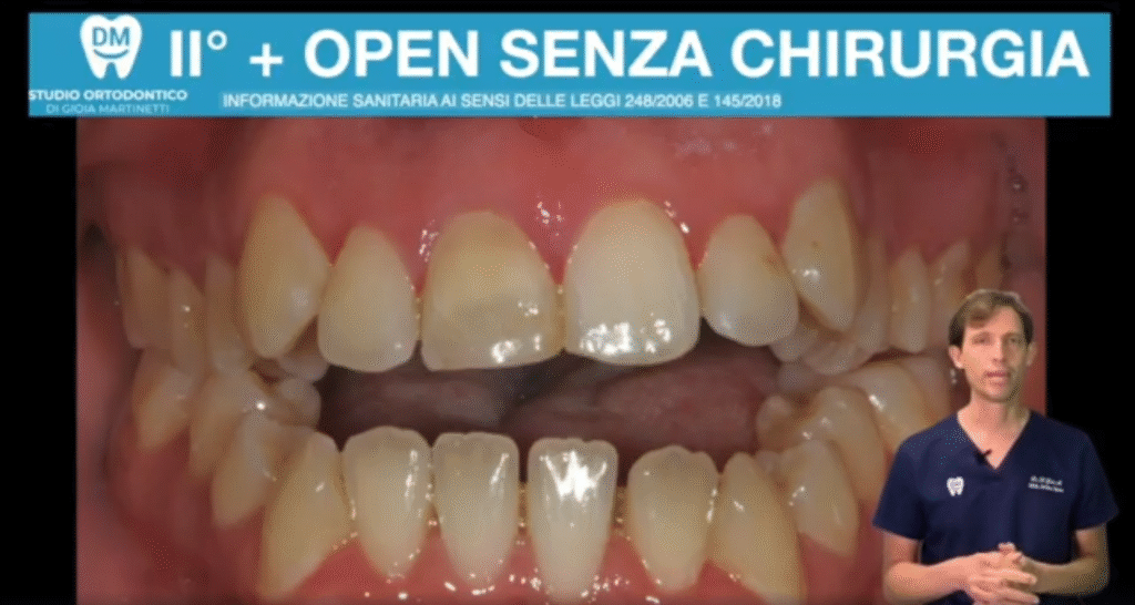 Morso aperto senza chirurgia