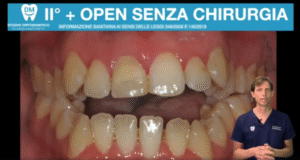 Morso aperto senza chirurgia