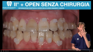 Morso aperto senza chirurgia