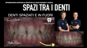 denti spaziati