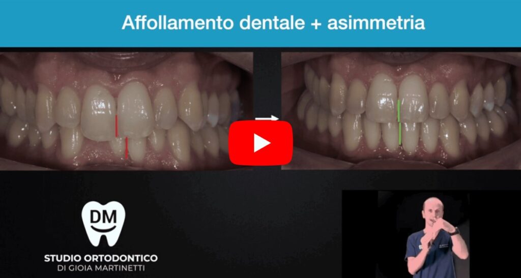 allineamento et&agrave; adulta