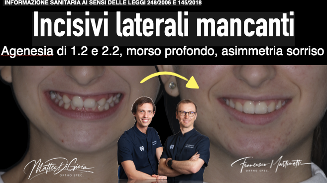 agenesia degli incisivi laterali