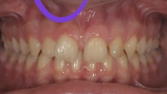 diastema nei ragazzi