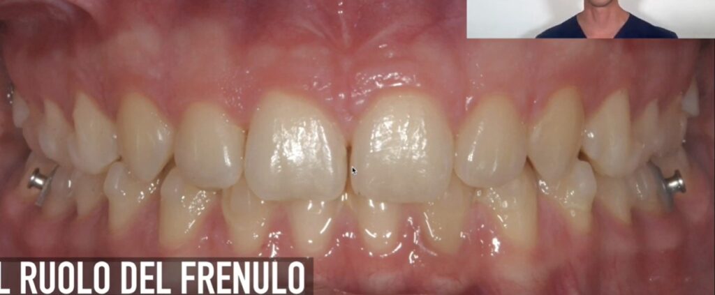 diastema nei ragazzi