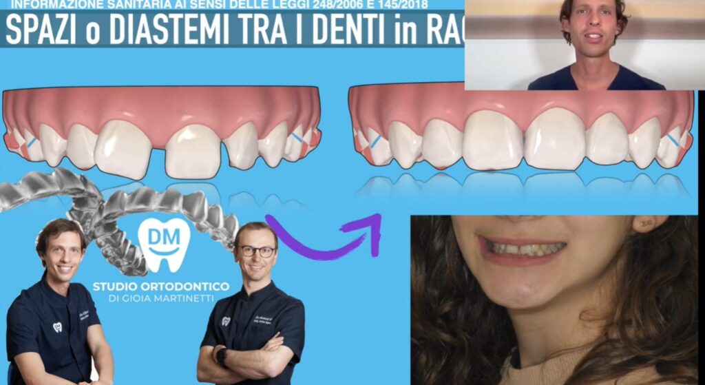 diastema nei ragazzi