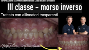 Morso inverso anteriore