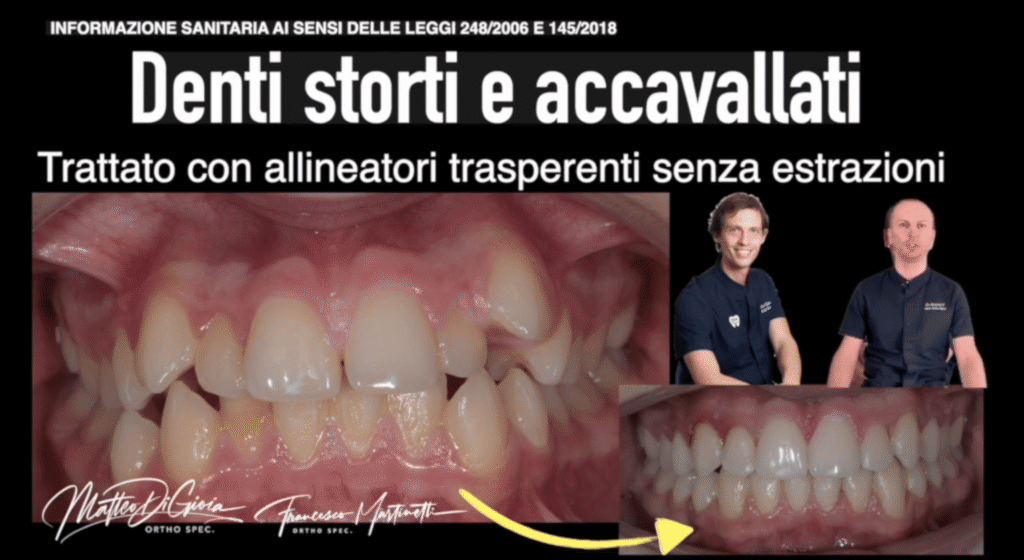 denti storti e accavallati