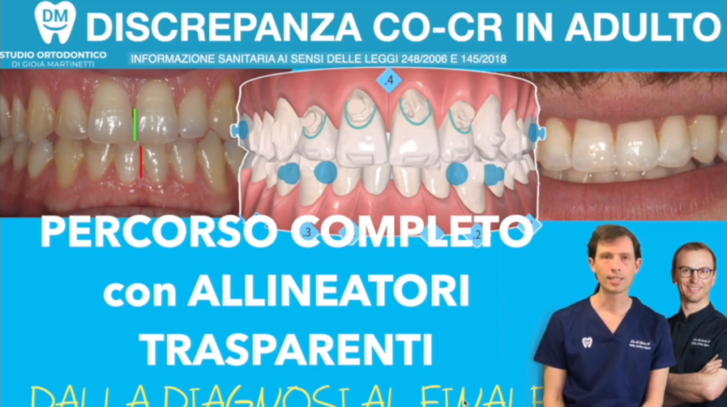 morso instabile e chiusura assimmetrica
