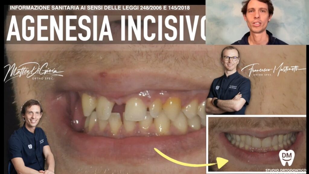 agenesia incisivo laterale e impianti