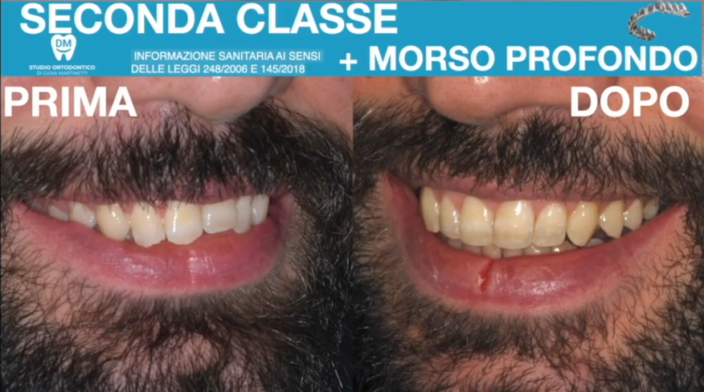 seconda classe e morso profondo