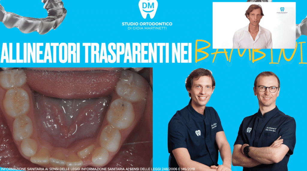 allineatori trasparenti bambini