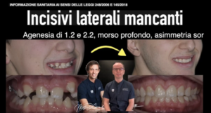 agenesia incisivi laterali superiori