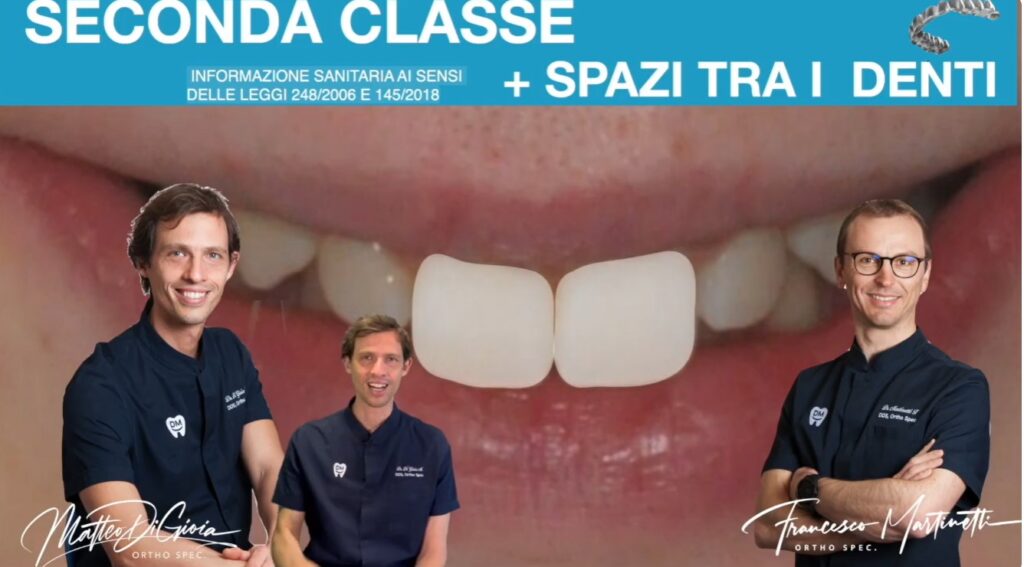 denti ion fuori seconda classe