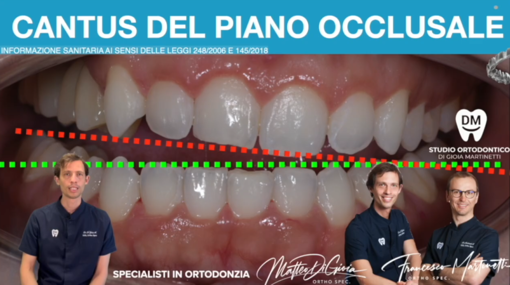 cantus del piano occlusale