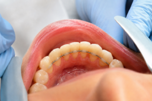 contenzione ortodontica